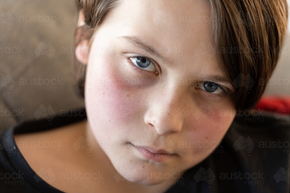 An unwell preteen boy lying on a couch looking at the camera, his cheeks are red from a fever - Australian Stock Image