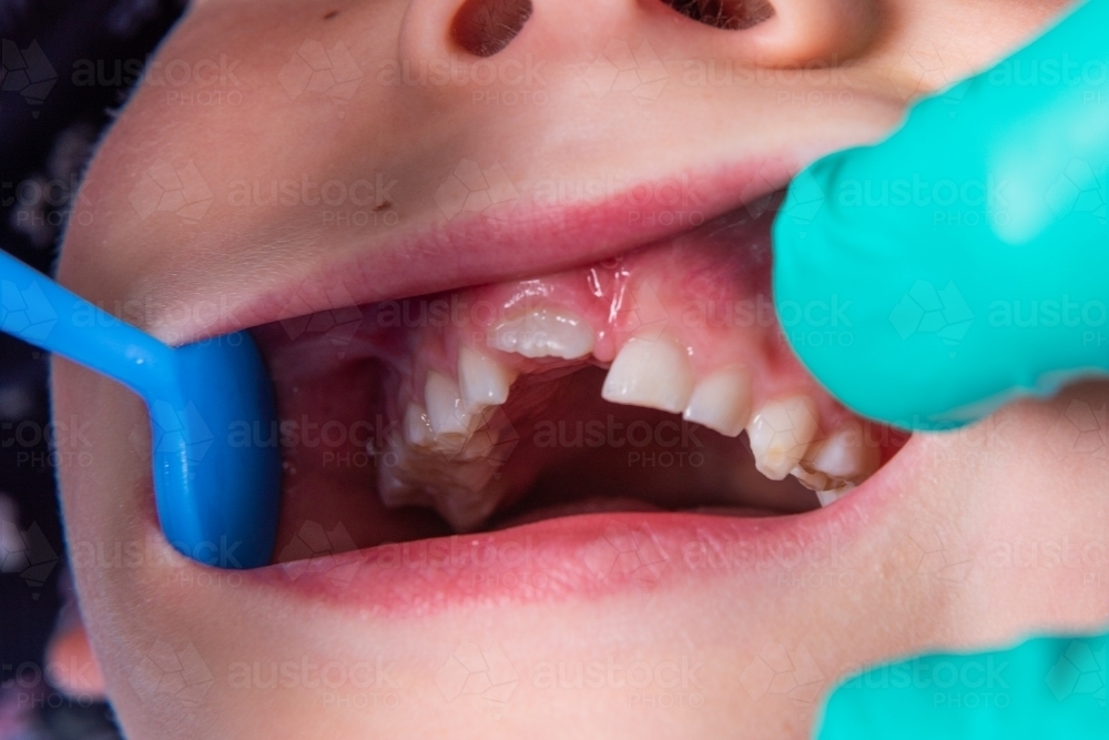 Child's new front tooth erupting - close view - Australian Stock Image