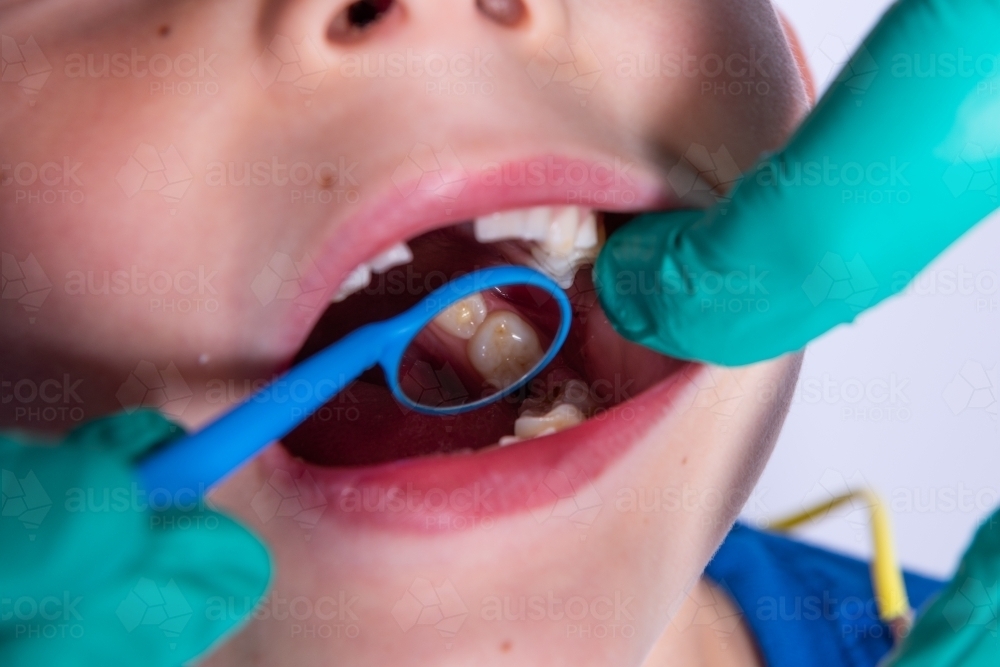 Dental mouth mirror checking child's teeth - Australian Stock Image