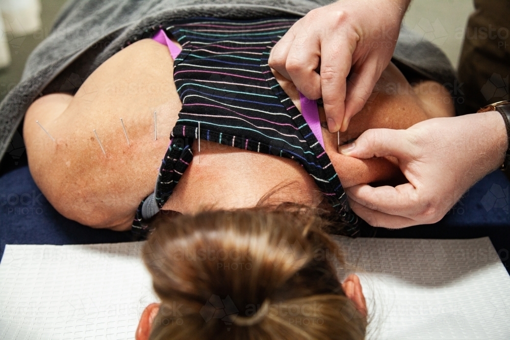 Dry needling for muscle relief - Australian Stock Image