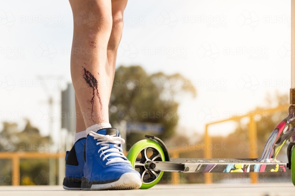 Injured leg with blood and scooter - Australian Stock Image