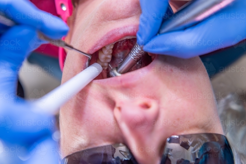 Lady having dental filling at dentist office - Australian Stock Image