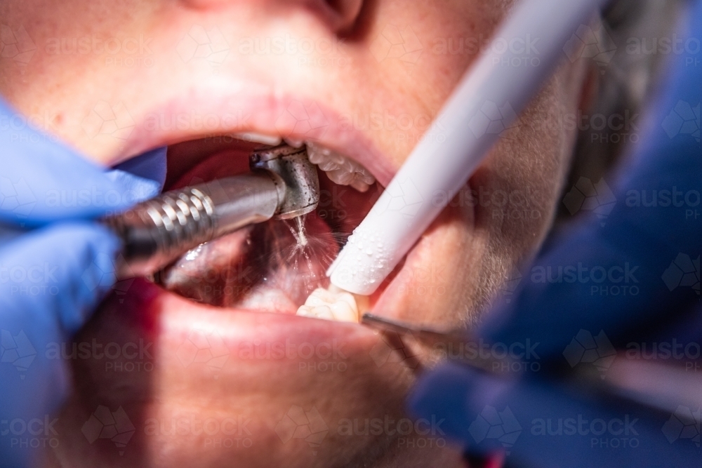 Lady having dental filling at dentist office - Australian Stock Image