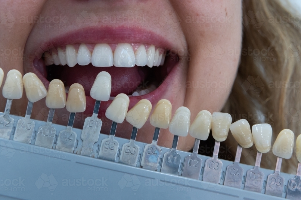 image-of-matching-teeth-colour-with-tooth-shade-guide-austockphoto