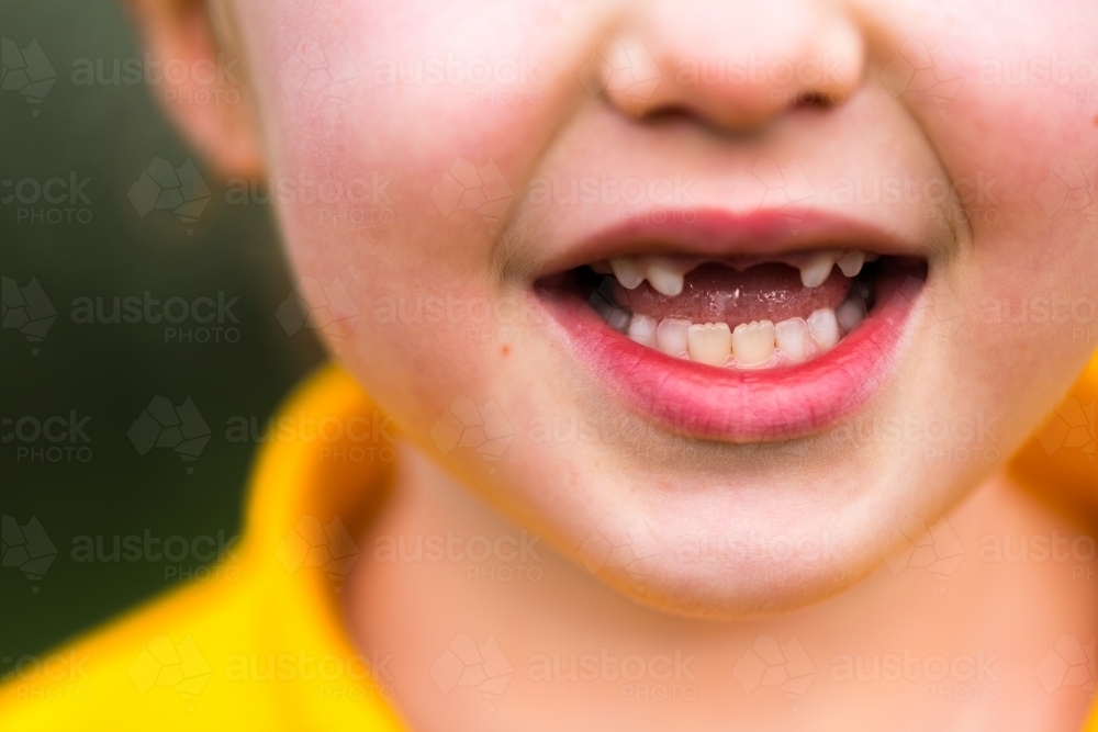 Young school girl showing her missing front teeth - Australian Stock Image