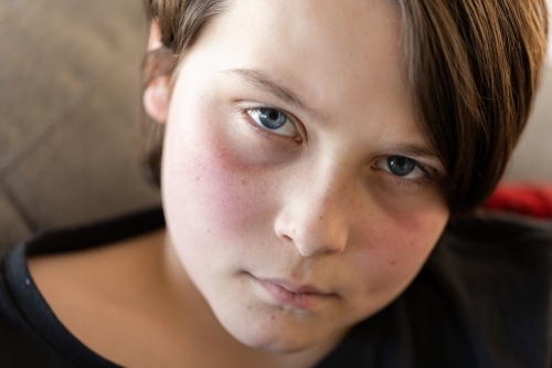 An unwell preteen boy lying on a couch looking at the camera, his cheeks are red from a fever - Australian Stock Image