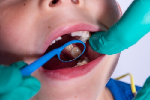 Dental mouth mirror checking child's teeth - Australian Stock Image